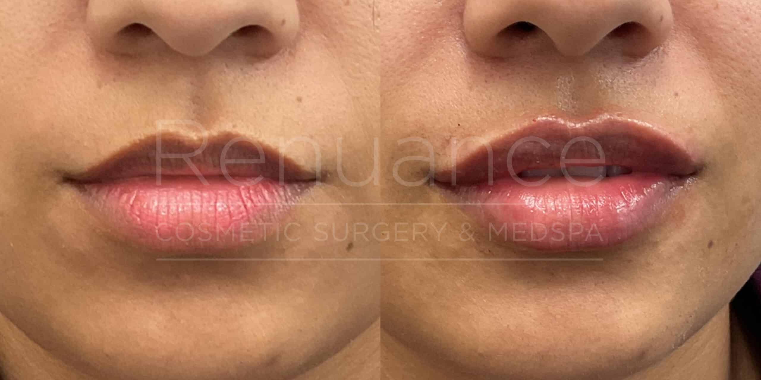 Renuance - Lip Filler before and after photo