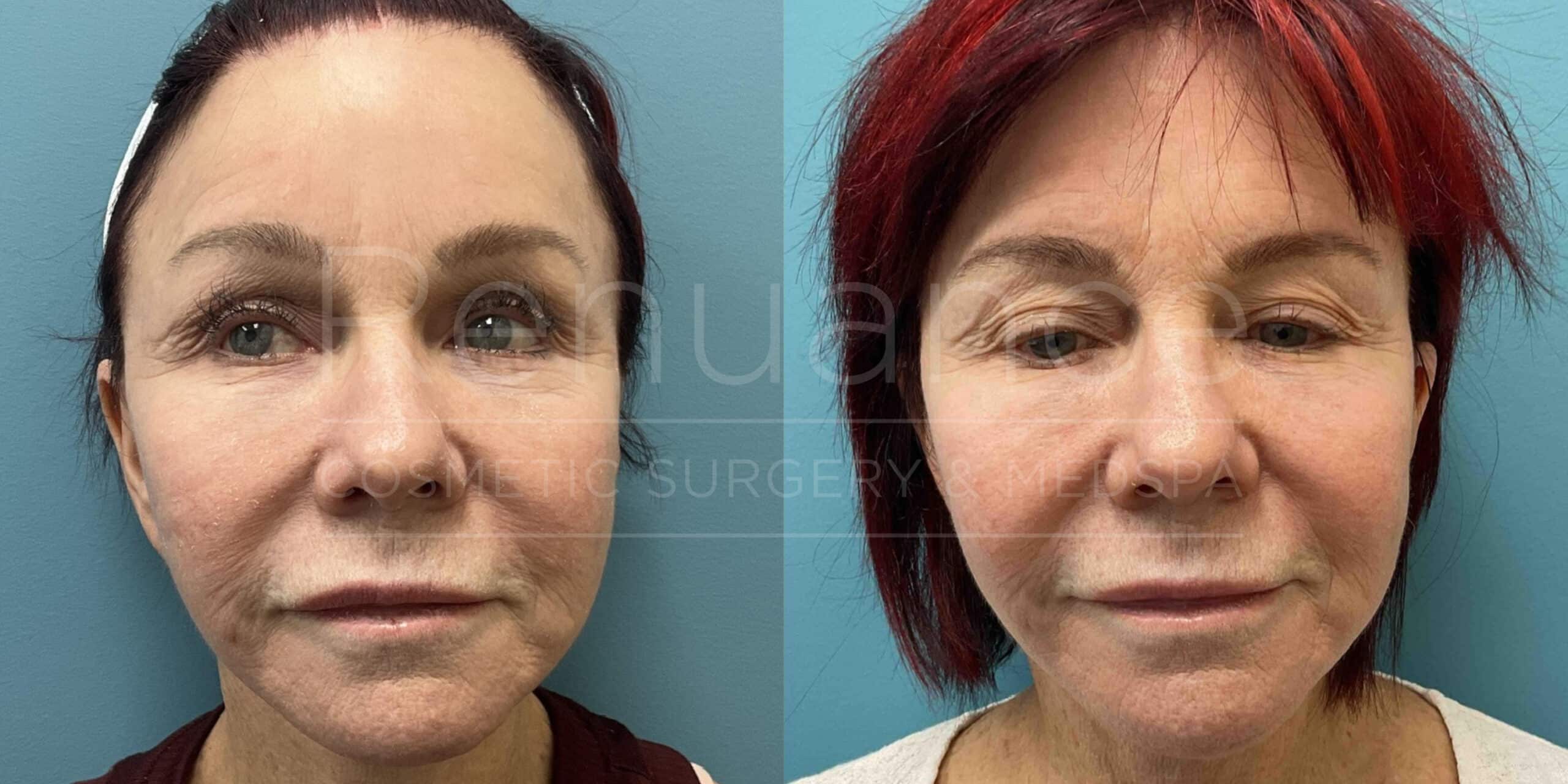 Renuance - Morpheus8 before and after photo - Angle 1