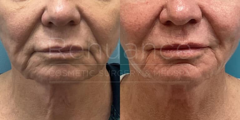 Renuance - Morpheus8 before and after photo