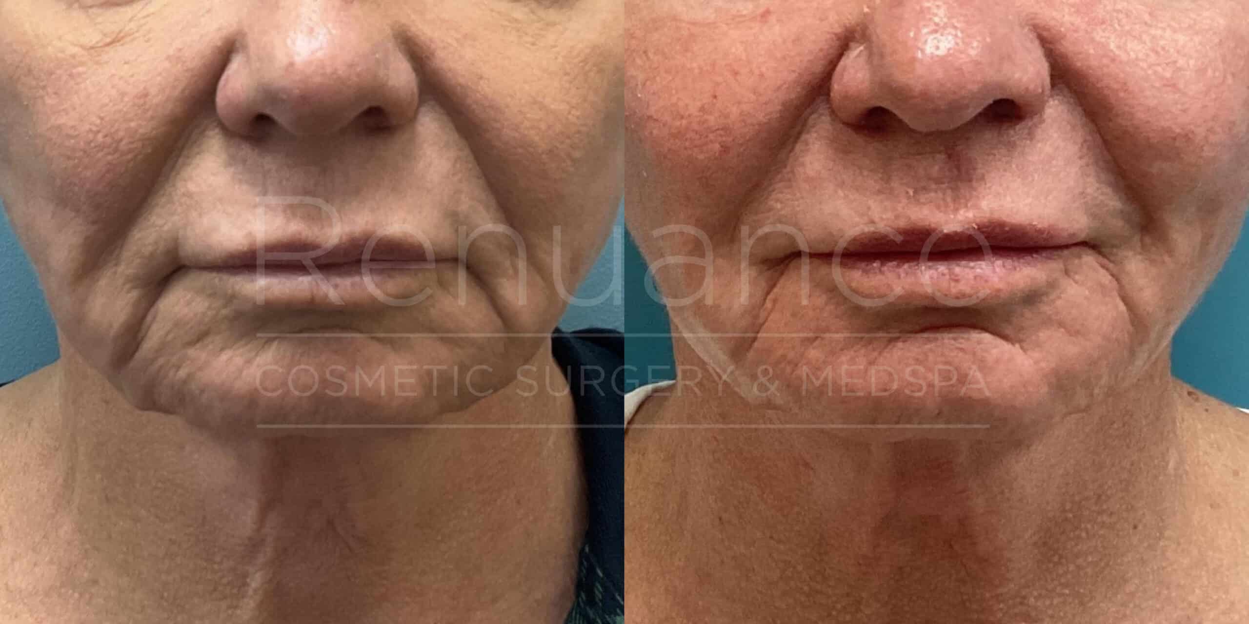 Renuance - Morpheus8 before and after photo