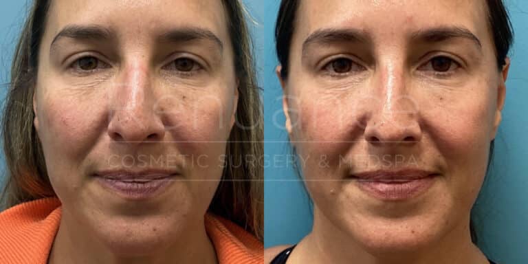 Renuance - Morpheus8 for the face and neck before and after photo