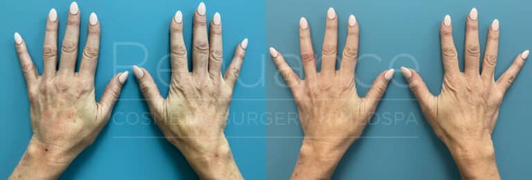 Renuance - Radiesse Hand Rejuvenation before and after photo
