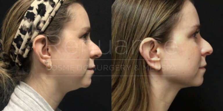 Renuance - Renuvion before and after photo