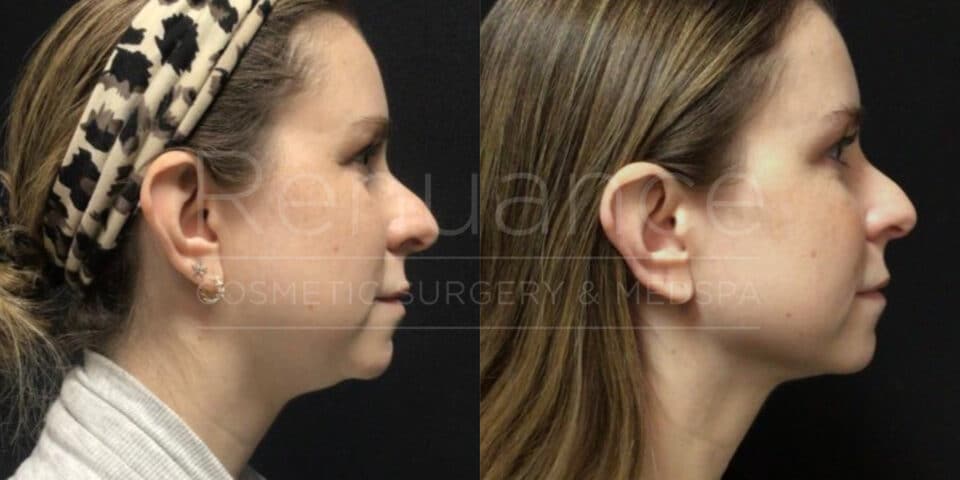 Renuance - Renuvion before and after photo